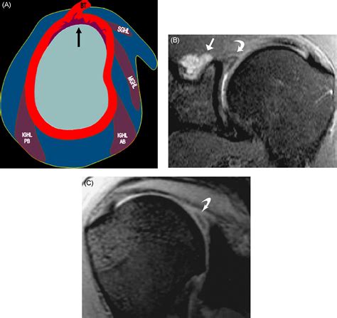 slap tear diagnosis pdf